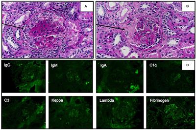 Atypical Neurological Manifestation in Childhood Microscopic Polyangiitis: A Case Report and Review of Literature